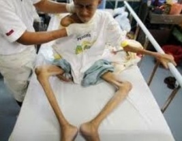 ilustrasi: pasien penyakit HIV AIDS