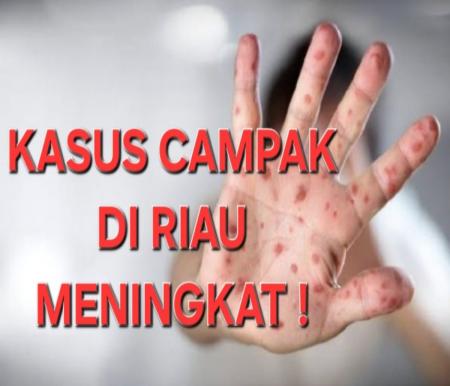 Ilustrasi lonjakan kasus campak di Riau (foto/int)